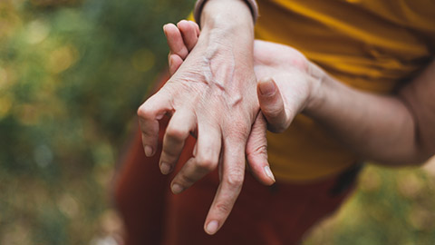 A womanâ€™s hand with the fingers twisted and swollen from lupus.