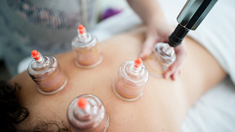 Massage cups on a client's back. 