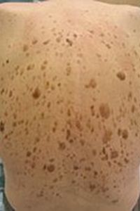 Seborrheic Keratosis