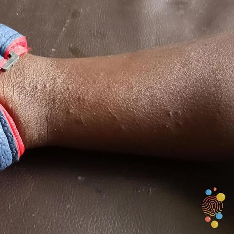 A person with dark skin who has folliculitis on their lower leg.