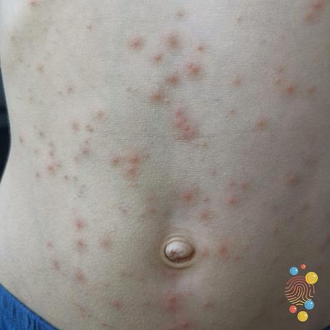 A person with white skin that has folliculitis.