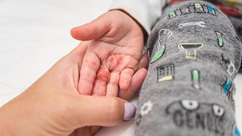 Image of a child with hand foot mouth disease.